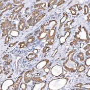 IHC staining of FFPE human prostate adenocarcinoma tissue with Cytokeratin 4 antibody. HIER: boil tissue sections in pH8 EDTA for 20 min and allow to cool before testing.