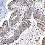 IHC staining of FFPE human endometrioid adenocarcinoma tissue with Cytokeratin 4 antibody. HIER: boil tissue sections in pH8 EDTA for 20 min and allow to cool before testing.