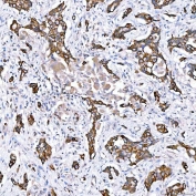 IHC staining of FFPE human lung adenocarcinoma tissue with Cytokeratin 4 antibody. HIER: boil tissue sections in pH8 EDTA for 20 min and allow to cool before testing.