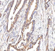 IHC staining of FFPE human pancreas ductal adenocarcinoma tissue with HSD17B13 antibody. HIER: boil tissue sections in pH8 EDTA for 20 min and allow to cool before testing.