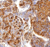 IHC staining of FFPE human liver cancer tissue with HSD17B13 antibody. HIER: boil tissue sections in pH8 EDTA for 20 min and allow to cool before testing.