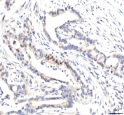IHC staining of FFPE human pancreas ductal adenocarcinoma tissue with IPO8 antibody. HIER: boil tissue sections in pH8 EDTA for 20 min and allow to cool before testing.