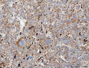 IHC staining of FFPE human liver cancer tissue with MRC1 antibody. HIER: boil tissue sections in pH8 EDTA for 20 min and allow to cool before testing.