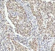 IHC staining of FFPE human colorectal adenocarcinoma tissue with TARDBP antibody. HIER: boil tissue sections in pH8 EDTA for 20 min and allow to cool before testing.