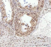 IHC staining of FFPE human ovarian cancer tissue with TARDBP antibody. HIER: boil tissue sections in pH8 EDTA for 20 min and allow to cool before testing.