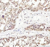 IHC staining of FFPE human liver cancer tissue with TARDBP antibody. HIER: boil tissue sections in pH8 EDTA for 20 min and allow to cool before testing.