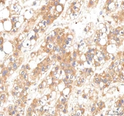 IHC staining of FFPE human liver cancer tissue with Plakophilin 2 antibody. HIER: boil tissue sections in pH8 EDTA for 20 min and allow to cool before testing.