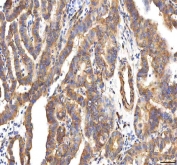 IHC staining of FFPE human thyroid papillary carcinoma tissue with PCPE1 antibody. HIER: boil tissue sections in pH8 EDTA for 20 min and allow to cool before testing.