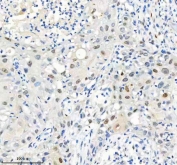 IHC staining of FFPE human urothelial carcinoma tissue with MACROH2A2 antibody. HIER: boil tissue sections in pH8 EDTA for 20 min and allow to cool before testing.