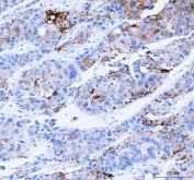 IHC staining of FFPE human liver cancer tissue with SCD1 antibody. HIER: boil tissue sections in pH8 EDTA for 20 min and allow to cool before testing.