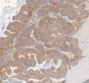 IHC staining of FFPE human ovarian tumor tissue with HDHD5 antibody. HIER: boil tissue sections in pH8 EDTA for 20 min and allow to cool before testing.