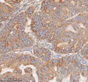 IHC staining of FFPE human ovarian tumor tissue with HDHD5 antibody. HIER: boil tissue sections in pH8 EDTA for 20 min and allow to cool before testing.