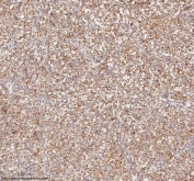 IHC staining of FFPE human testicular seminoma tissue with HDHD5 antibody. HIER: boil tissue sections in pH8 EDTA for 20 min and allow to cool before testing.