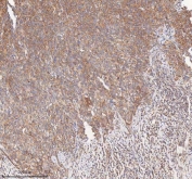 IHC staining of FFPE human cervix squamous cell carcinoma tissue with HDHD5 antibody. HIER: boil tissue sections in pH8 EDTA for 20 min and allow to cool before testing.