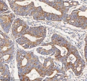 IHC staining of FFPE human colon adenocarcinoma tissue with PCCA antibody. HIER: boil tissue sections in pH8 EDTA for 20 min and allow to cool before testing.