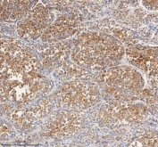 IHC staining of FFPE human liver cancer tissue with PCCA antibody. HIER: boil tissue sections in pH8 EDTA for 20 min and allow to cool before testing.