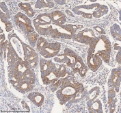 IHC staining of FFPE human colon adenocarcinoma tissue with PCCA antibody. HIER: boil tissue sections in pH8 EDTA for 20 min and allow to cool before testing.