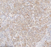 IHC staining of FFPE human urothelial carcinoma tissue with PCCA antibody. HIER: boil tissue sections in pH8 EDTA for 20 min and allow to cool before testing.