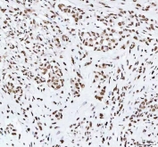 IHC staining of FFPE human lung adenocarcinoma tissue with RNA-binding motif protein 3 antibody. HIER: boil tissue sections in pH8 EDTA for 20 min and allow to cool before testing.