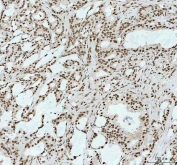 IHC staining of FFPE human prostate cancer tissue with RNA-binding motif protein 3 antibody. HIER: boil tissue sections in pH8 EDTA for 20 min and allow to cool before testing.