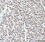 IHC staining of FFPE human testicular germ cell tumor tissue with RNA-binding motif protein 3 antibody. HIER: boil tissue sections in pH8 EDTA for 20 min and allow to cool before testing.