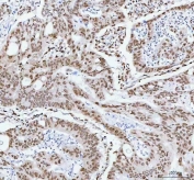IHC staining of FFPE human colorectal adenocarcinoma tissue with RNA-binding motif protein 3 antibody. HIER: boil tissue sections in pH8 EDTA for 20 min and allow to cool before testing.