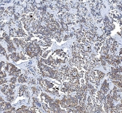 IHC staining of FFPE human pancreatic cancer tissue with Cyclooxygenase 2 antibody. HIER: boil tissue sections in pH8 EDTA for 20 min and allow to cool before testing.