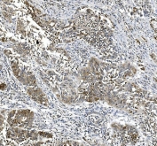 IHC staining of FFPE human lung cancer tissue with Cyclooxygenase 2 antibody. HIER: boil tissue sections in pH8 EDTA for 20 min and allow to cool before testing.