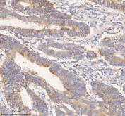 IHC staining of FFPE human colon adenocarcinoma tissue with HER4 antibody. HIER: boil tissue sections in pH8 EDTA for 20 min and allow to cool before testing.
