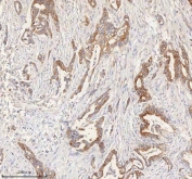 IHC staining of FFPE human pancreas ductal adenocarcinoma tissue with HER4 antibody. HIER: boil tissue sections in pH8 EDTA for 20 min and allow to cool before testing.