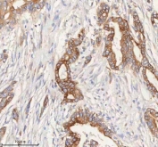 IHC staining of FFPE human pancreas ductal adenocarcinoma tissue with HER4 antibody. HIER: boil tissue sections in pH8 EDTA for 20 min and allow to cool before testing.