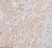 IHC staining of FFPE human urothelial carcinoma tissue with HER4 antibody. HIER: boil tissue sections in pH8 EDTA for 20 min and allow to cool before testing.