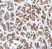 IHC staining of FFPE human lung cancer tissue with PKDCC antibody. HIER: boil tissue sections in pH8 EDTA for 20 min and allow to cool before testing.