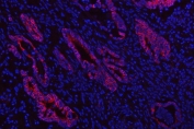 Immunofluorescent staining of FFPE human intestinal cancer tissue with PKDCC antibody (red) and DAPI nuclear stain (blue). HIER: steam section in pH8 EDTA buffer for 20 min.