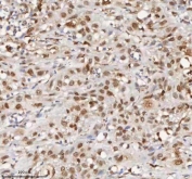 IHC staining of FFPE human urothelial carcinoma tissue with MACROH2A1 antibody. HIER: boil tissue sections in pH8 EDTA for 20 min and allow to cool before testing.