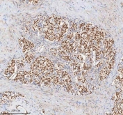 IHC staining of FFPE human lung adenocarcinoma tissue with MACROH2A1 antibody. HIER: boil tissue sections in pH8 EDTA for 20 min and allow to cool before testing.