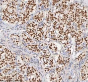 IHC staining of FFPE human lung adenocarcinoma tissue with MACROH2A1 antibody. HIER: boil tissue sections in pH8 EDTA for 20 min and allow to cool before testing.