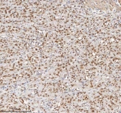 IHC staining of FFPE human urothelial carcinoma tissue with MACROH2A1 antibody. HIER: boil tissue sections in pH8 EDTA for 20 min and allow to cool before testing.