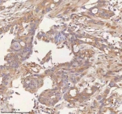 IHC staining of FFPE human pancreas ductal adenocarcinoma tissue with ITPRIP antibody. HIER: boil tissue sections in pH8 EDTA for 20 min and allow to cool before testing.