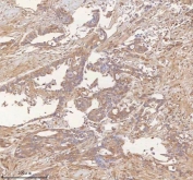 IHC staining of FFPE human pancreas ductal adenocarcinoma tissue with ITPRIP antibody. HIER: boil tissue sections in pH8 EDTA for 20 min and allow to cool before testing.