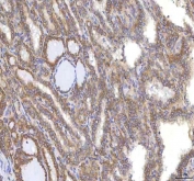 IHC staining of FFPE human thyroid cancer tissue with Oncomodulin 1 antibody. HIER: boil tissue sections in pH8 EDTA for 20 min and allow to cool before testing.
