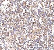 IHC staining of FFPE human testicular seminoma tissue with HSDL2 antibody. HIER: boil tissue sections in pH8 EDTA for 20 min and allow to cool before testing.