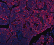 Immunofluorescent staining of FFPE human ovarian cancer tissue with Peptide deformylase antibody (red) and DAPI nuclear stain (blue). HIER: steam section in pH8 EDTA buffer for 20 min.