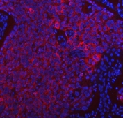 Immunofluorescent staining of FFPE human esophageal squamous cell carcinoma tissue with Peptide deformylase antibody (red) and DAPI nuclear stain (blue). HIER: steam section in pH8 EDTA buffer for 20 min.