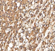 IHC staining of FFPE human liver cancer tissue with Peptide deformylase antibody. HIER: boil tissue sections in pH8 EDTA for 20 min and allow to cool before testing.
