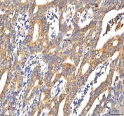 IHC staining of FFPE human colon adenocarcinoma tissue with Peptide deformylase antibody. HIER: boil tissue sections in pH8 EDTA for 20 min and allow to cool before testing.