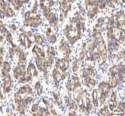 IHC staining of FFPE human lung cancer tissue with Peptide deformylase antibody. HIER: boil tissue sections in pH8 EDTA for 20 min and allow to cool before testing.
