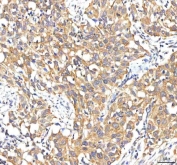 IHC staining of FFPE human urothelial carcinoma tissue with Peptide deformylase antibody. HIER: boil tissue sections in pH8 EDTA for 20 min and allow to cool before testing.