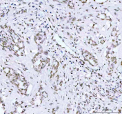 IHC staining of FFPE human lung adenocarcinoma tissue with Phospho-AKT1 Antibody. HIER: boil tissue sections in pH8 EDTA for 20 min and allow to cool before testing.