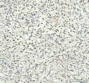 IHC staining of FFPE human intestinal diffuse large B-cell lymphoma tissue with Phospho-AKT1 Antibody. HIER: boil tissue sections in pH8 EDTA for 20 min and allow to cool before testing.